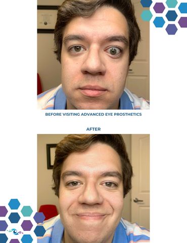 Before photo of a man wearing an old prosthetic eye and After photo wearing a new one.