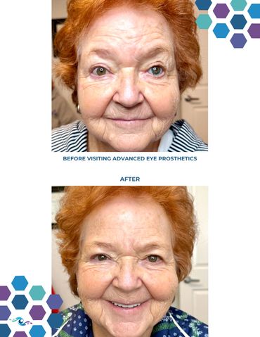 Before photo of a woman wearing an old prosthetic eye and After photo wearing a new one.