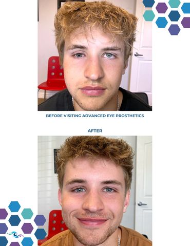 Before photo of a teenage boy wearing an old prosthetic eye and After photo wearing a new one.
