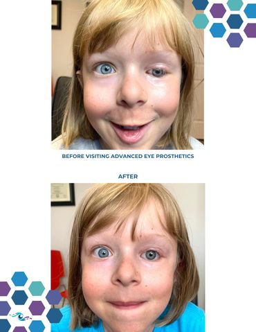 Before photo of a young girl wearing an old prosthetic eye and After photo wearing a new one.