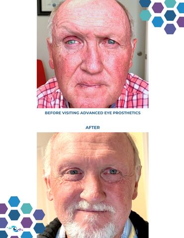 Before photo of a man wearing an old prosthetic eye and After photo wearing a new one.
