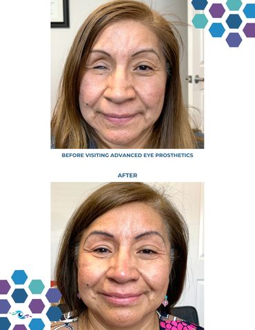 Before photo of a woman with a damaged live eye and After photo wearing a new scleral shell.