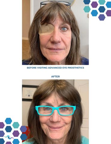Before photo of a woman wearing an eye patch and After photo wearing a prosthetic eye.