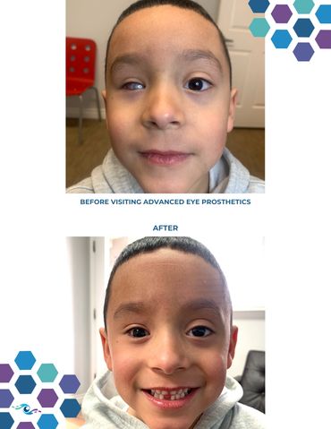 Before photo of a young boy with a damaged live eye and After photo wearing a new scleral shell.