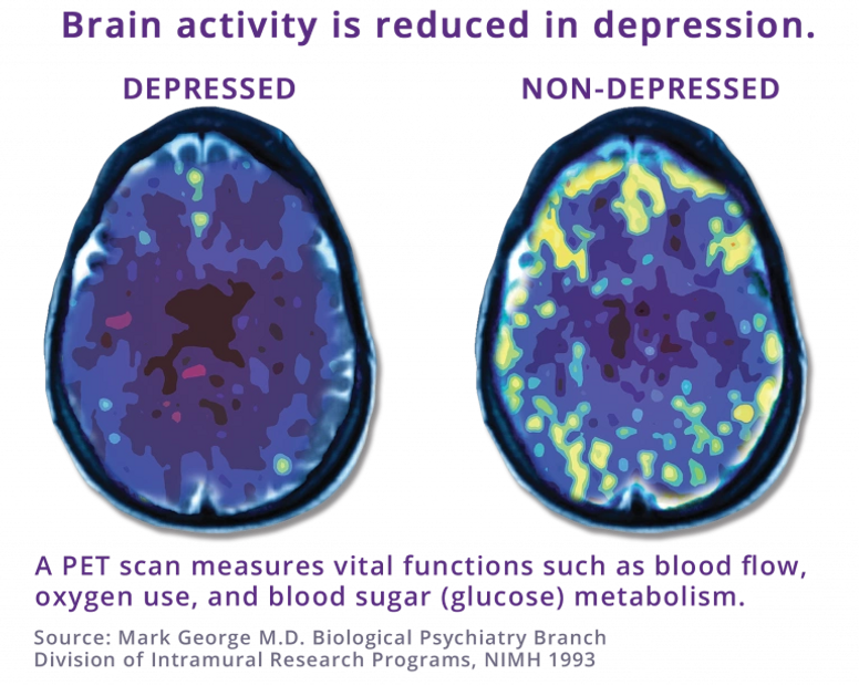 Brain activity of depressed person vs. non-depressed person.