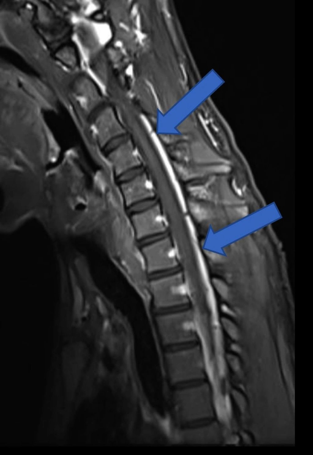 Flexion MRI for hirayama disease