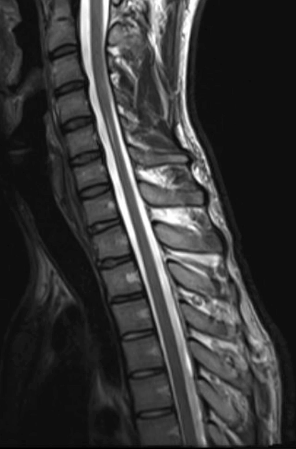 Sagittal T2 MRI of cervical spine showing normal canal dimensions