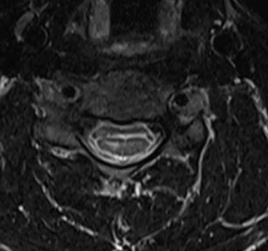 Hirayama disease: Axial T2 MRI of cervical spine showing right hemicord signal changes