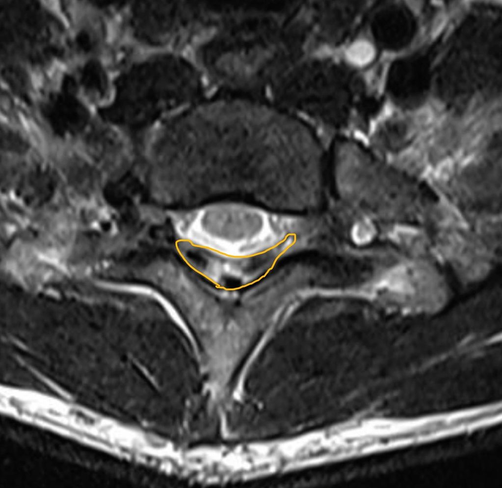 Flexion MRI for hirayama disease