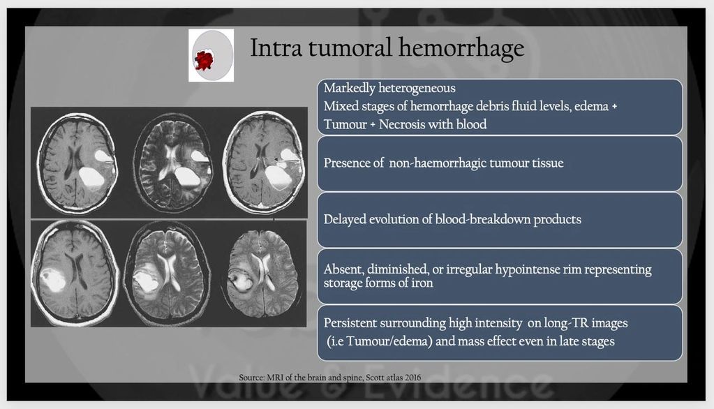 Clues to differentiate neoplastic vs non-neoplastic etiology
Intratumoral hemorrhage