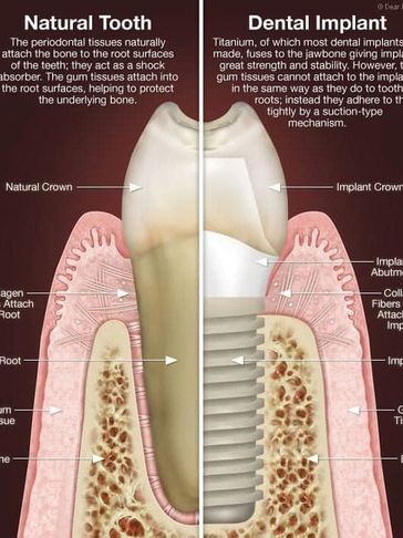 Your DENTAL IMPLANT IN CANCUN can replace the size and function as a natural teeth 