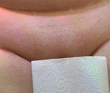 Close-up of skin with visible hair follicles and a piece of textured paper towel.