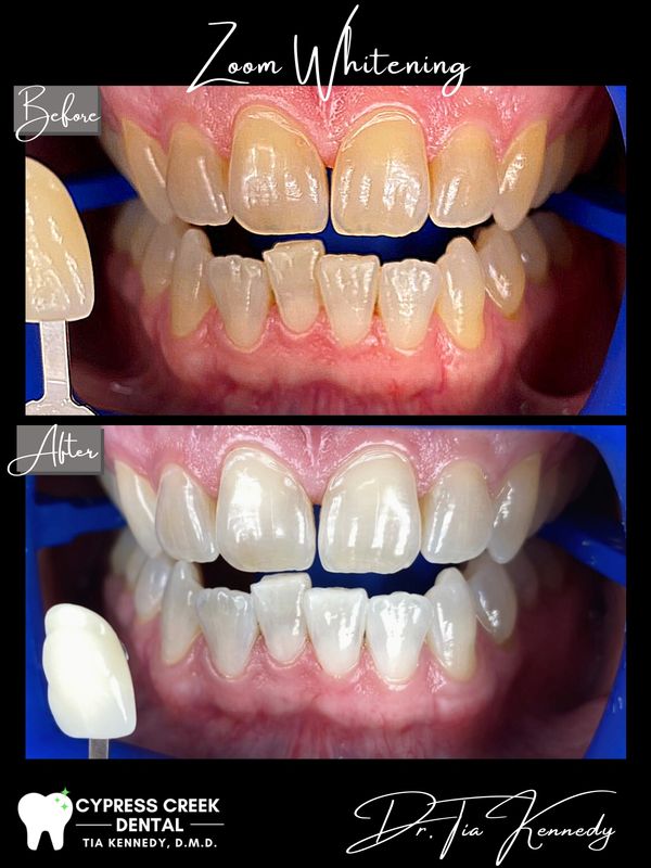 Teeth Whitening Florence AL