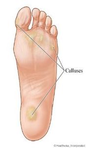 Callus