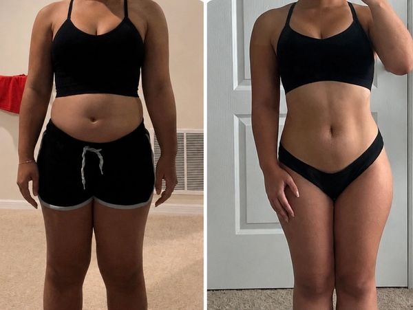 Before-and-after photos of a female patient showing her progress during a medically supervised weigh