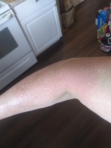 Sunburn 24 hours later