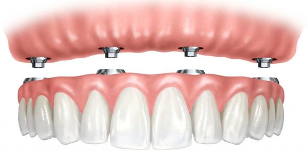 Edmonton Dentures|Dental Implants|All on four Dentures|Implant Dentures|Alberta Dentures|Denturist
