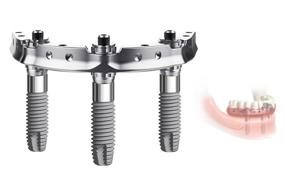 Trefoil Implant, Nobel Biocare, Implants, Teeth in a day, Titanium Bar, Implants, Implant Dentures