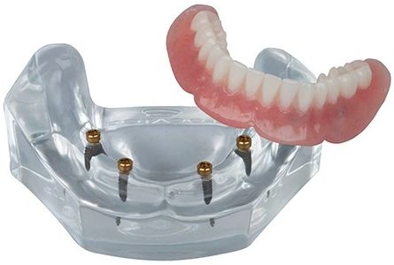 Edmonton Dentures|Dental Implants|Locator Dentures|Implant Dentures|Alberta Dentures|Denturist