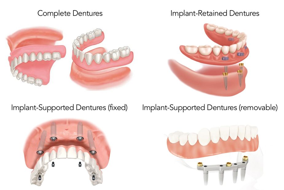 Edmonton Dentures|Dental Implants|Complete Dentures|Implant Dentures|Alberta Dentures|Denturist