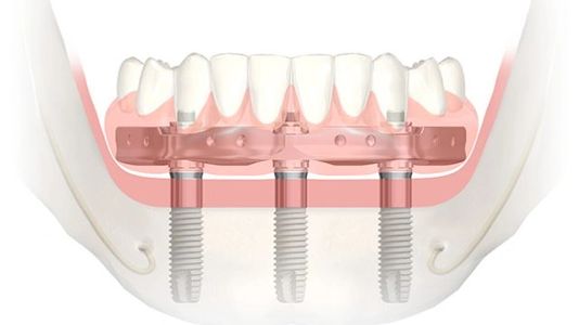 Edmonton Dentures|Dental Implants|All on four Dentures|Implant Dentures|Nobel Trefoil|Denturist