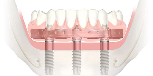Edmonton Dentures|Dental Implants|All on four Dentures|Implant Dentures|Nobel Trefoil|Denturist