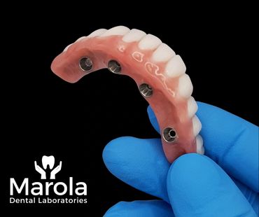 Implant retained denture made at Marola Dental prosthetic laboratory in Berkshire