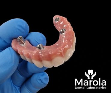 Implant retained denture made at Marola Dental prosthetic laboratory in Berkshire