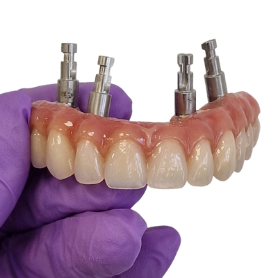 Implant retained denture made at Marola Dental prosthetic laboratory in Berkshire