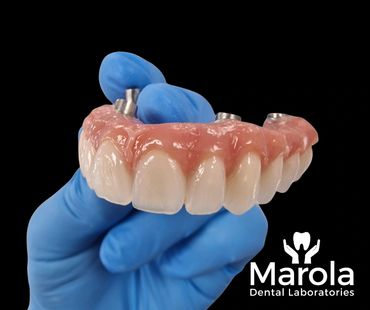 Implant retained denture made at Marola Dental prosthetic laboratory in Berkshire