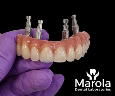 Implant retained denture made at Marola Dental prosthetic laboratory in Berkshire