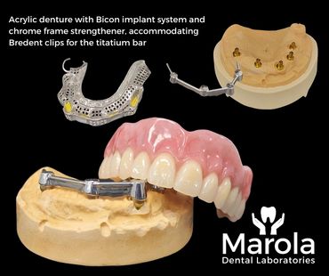 Implant retained denture made at Marola Dental prosthetic laboratory in Berkshire