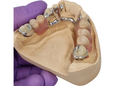 Chrome denture made at Marola Dental prosthetic laboratory in Berkshire