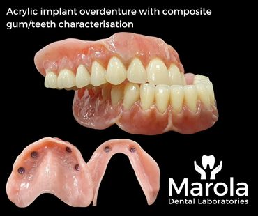 Implant retained denture made at Marola Dental prosthetic laboratory in Berkshire