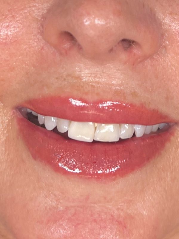 LIP BLUSH IN HINSDALE. LIP BLUSHING BURR RIDGE