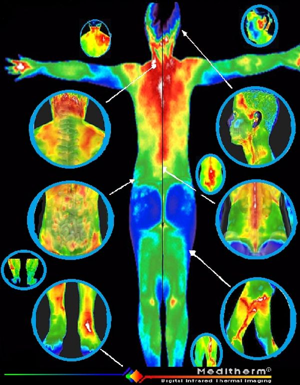 Digital Infrared Thermal Imaging in Sports Medicine and Musculoskeletal Disorders
DITI has been show