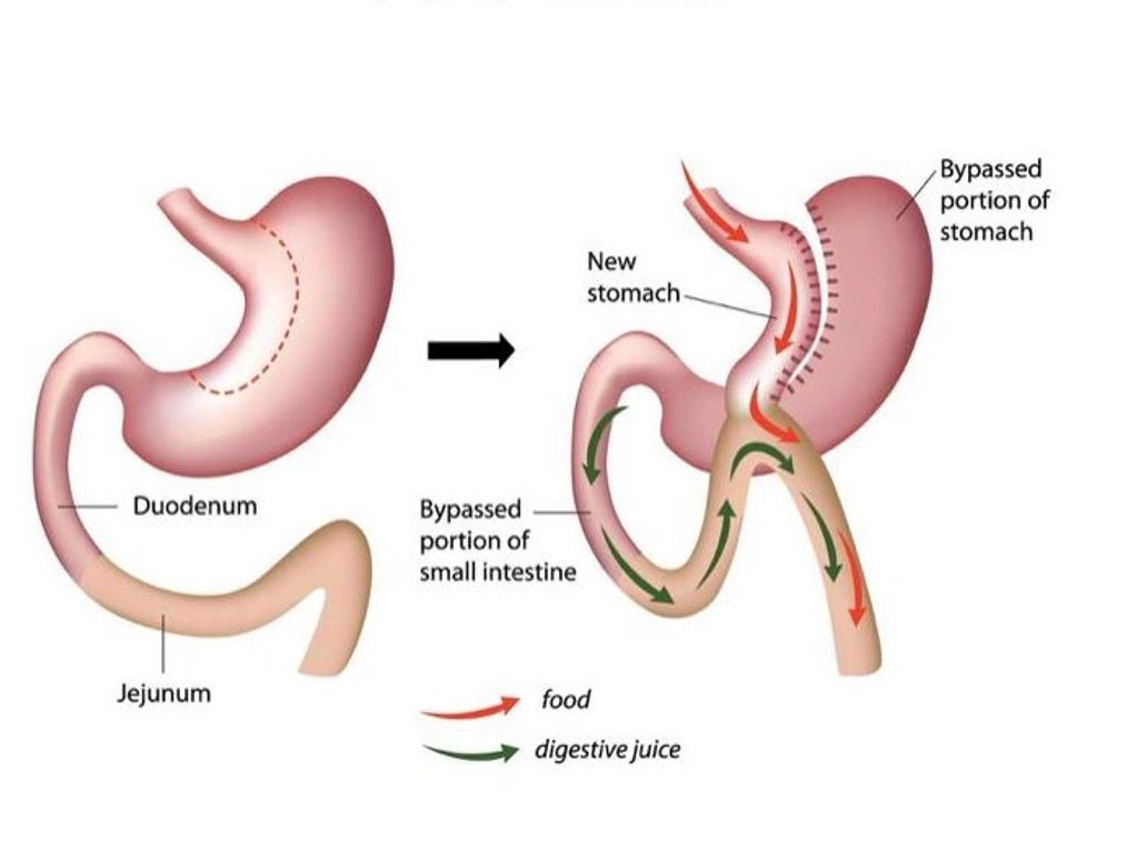 Mini Gastric Bypass