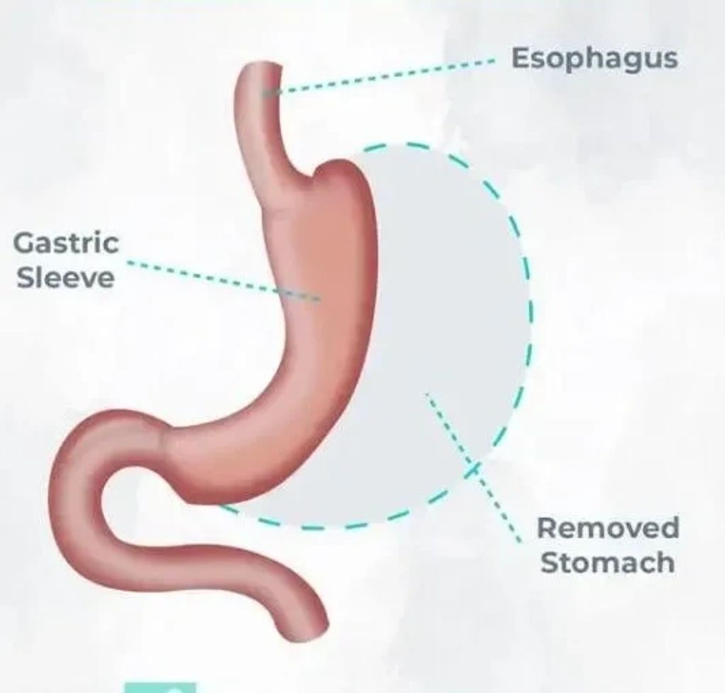 Gastric Sleeve