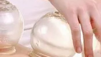 Cupping therapy