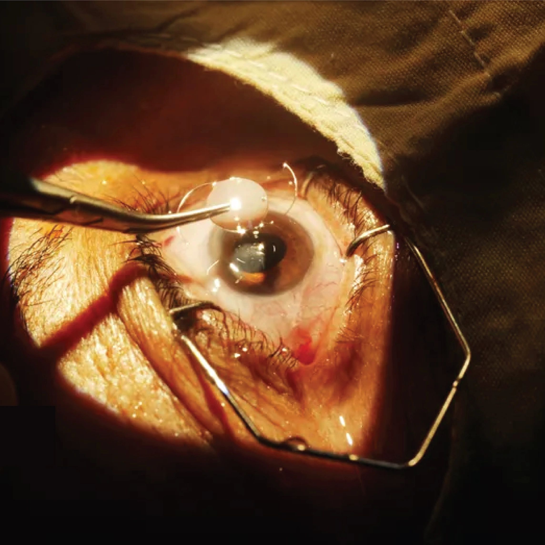 Close-up of eye surgery with an instrument holding a lens over the eye.