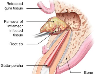 Diagram showing removal of infected tissue from tooth root tip.
