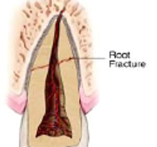 Illustration of a tooth with root fracture.