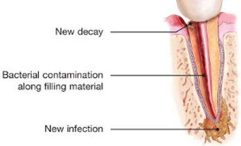 Diagram showing dental decay and infection progression.