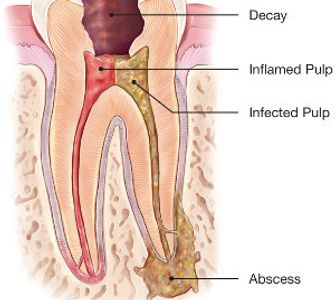 Cross-section of tooth showing decay, inflamed pulp, infected pulp, and abscess.