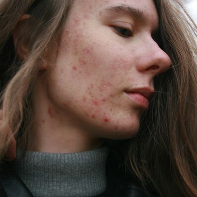 Side profile of a woman with acne.