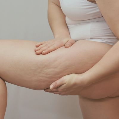 Photograph of woman's thigh with cellulite.