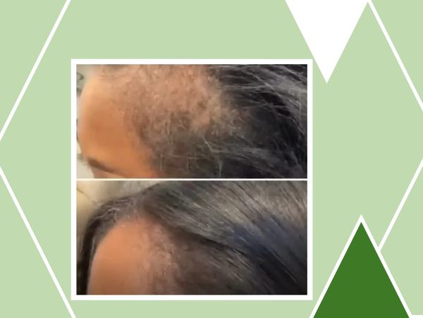 Gives your a hair it's original full texture, promotes hair growth and regrowth, may be used as a tr