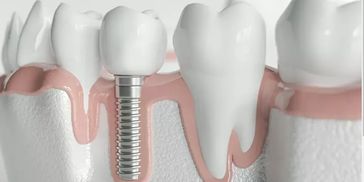 #Fairviewdental #DentistSantaAna #DentalSantaAna #DentalImplant #DentalofficeSantaAna #Dentista