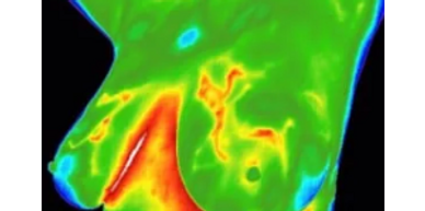 Vascular changes in breast are seen with thermal imaging.