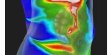 Inflammation causing digestive disorders.